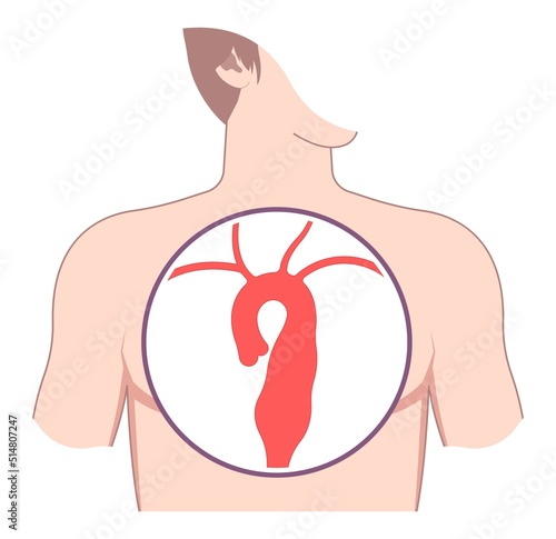 aortic arch damage and vein dilated left aorta root bulge of Turner Marfan Syndrome chest disorder heart attack stroke graft for pain with hernia high blood vessel clots and stent open renal kidney photo