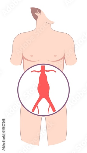 aortic arch damage and vein dilated left aorta root bulge of Turner Marfan Syndrome chest disorder heart attack stroke graft for pain with hernia high blood vessel clots and stent open renal kidney