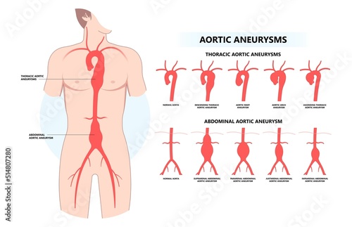 left aorta root bulge heart blood vessel clots aortic arch damage and vein dilated of Turner Marfan Syndrome chest disorder attack stroke graft for pain with hernia high stent open renal kidney photo