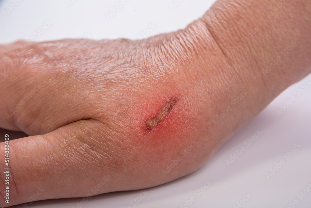 Fototapeta premium Burn on female hand from a cooking pot on a white