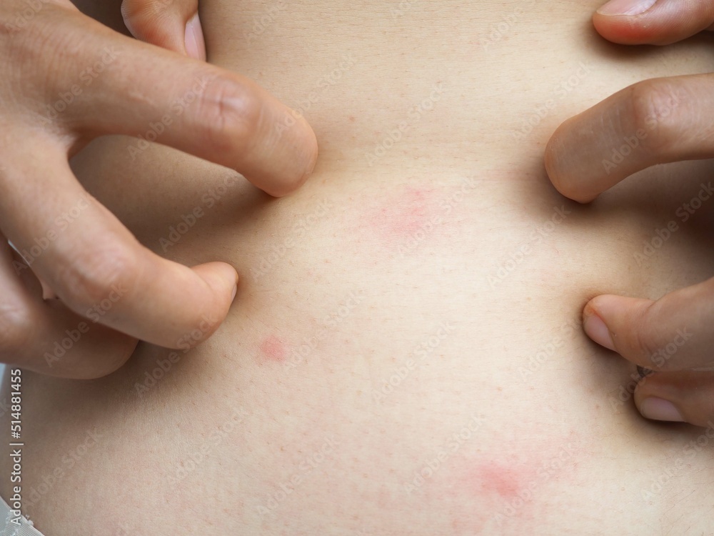 Young woman hand scratching an itch on red point sensitive skin as food or pest allergy symptoms on white background. closeup photo, blurred. Young woman hand scratching an itch on red point sensitive skin as food or pest allergy symptoms on white background. closeup photo, blurred.