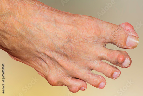 Severe gout in men suffering from joint pain, bone pain, gout, rheumatoid symptoms, radioactive sickness, ill man concept of male osteoporosis, injured bone, injury, pain, arthritis,arm, foot, knee