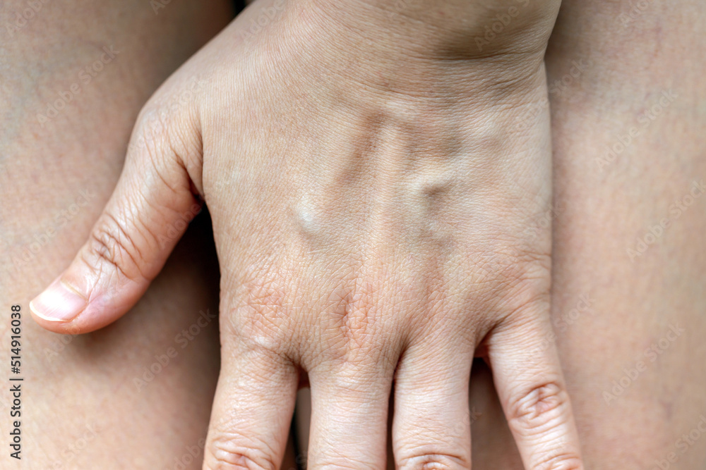 Painful varicose and spider veins on womans legs ,active life concept. Painful varicose and spider veins on womans legs ,active life concept.