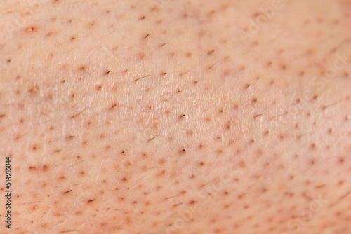 Closeup of caucasian skin with ingrown hair