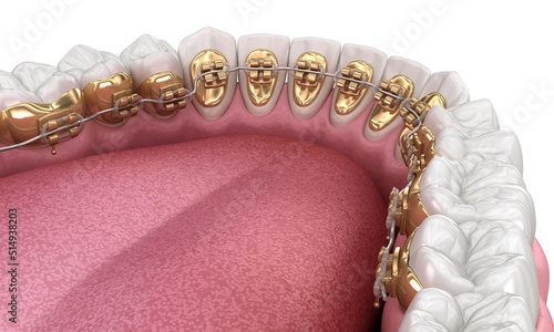 Healthy Teeth with gold braces, white style concept, dental 3D illustration photo