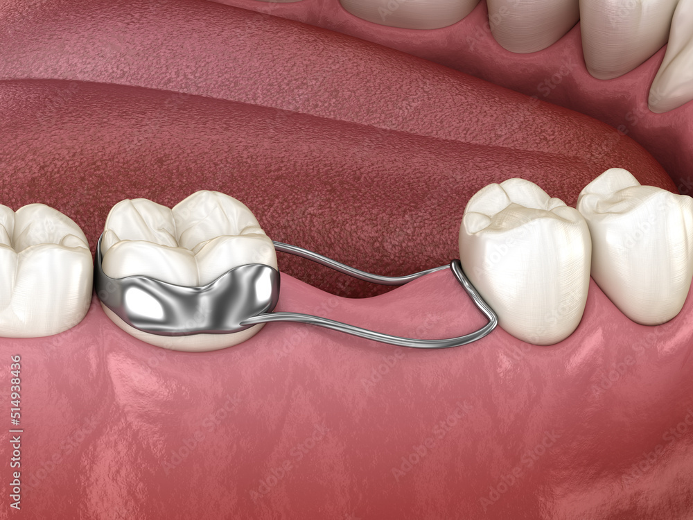 Space Maintainer Unilateral keeps from teeth shift deformatiuon after