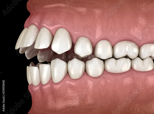 Openbite dental occlusion (Malocclusion of teeth). Medically accurate tooth 3D illustration