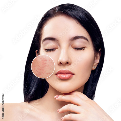 Young woman with couperose on face skin. Zoom circle shows skin problems.