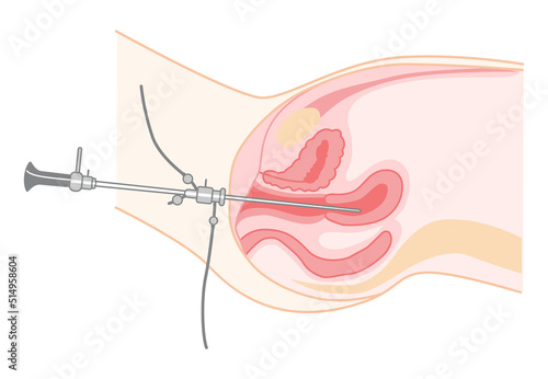 Hysteroscopy of Female reproductive system treat examine Diagnostic uterus. Side view in a cut. Human anatomy internal organs location scheme flat style icon. Vector medical illustration isolated photo