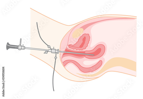 Hysteroscopy of Female reproductive system treat examine Diagnostic uterus. Side view in a cut. Human anatomy internal organs location scheme flat style icon. Vector medical illustration isolated