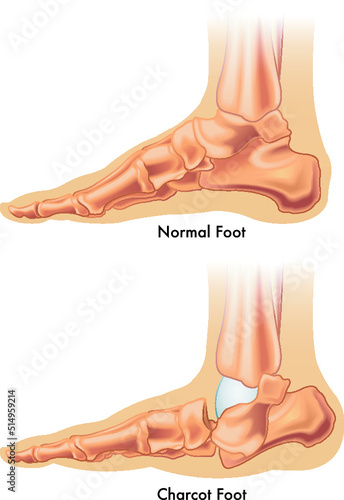 Medical illustration shows the difference between a normal foot and a charcot foot.