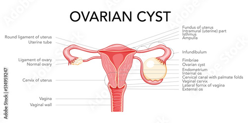 Ovarian cyst diagram Female reproductive system uterus labeled in Anatomical infographic. Front view gynecological disease. Human anatomy internal organs location scheme, cervix, ovary flat style icon