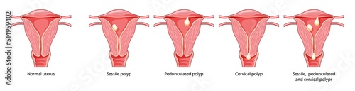 Set of Polyps in the uterus Female reproductive system in cross sections diseases and normal. Front view in a cut. Human anatomy internal organs location scheme, cervix, ovary flat style icon