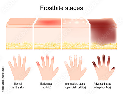Frostbite stages. skin injury after freezing