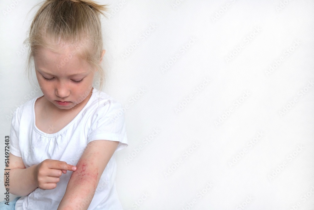 The child scratches atopic skin. Dermatitis, diathesis, allergy on the child's body. The child scratches atopic skin. Dermatitis, diathesis, allergy on the child's body.