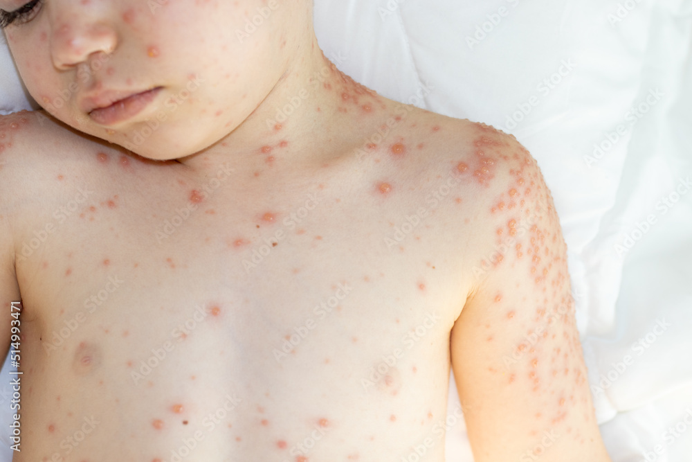 little-baby-boy-with-severe-form-of-varicella-chickenpox-virus-lot-of
