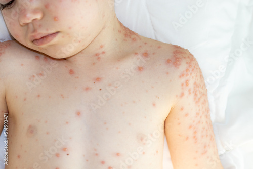 Fotografie little baby boy with severe form of varicella,chickenpox virus