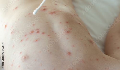 Fotografía little baby boy with severe form of varicella,chickenpox virus