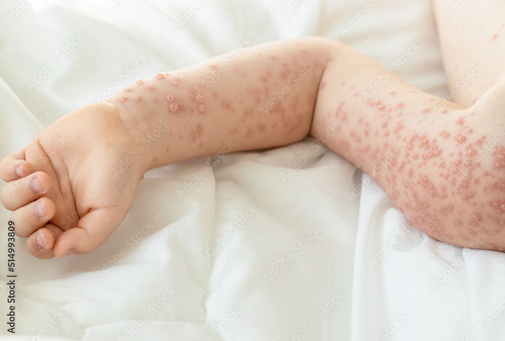 little-baby-boy-with-severe-form-of-varicella-chickenpox-virus-lot-of