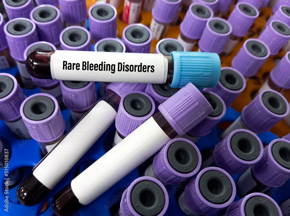 Blood sample for Rare Bleeding Disorders(RBDs) test, factor XI test