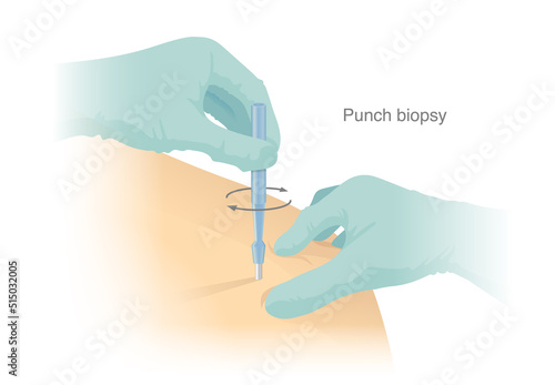 Biopsy punches. Cut sample tissue at the shoulder of the Patient with a medical instrument for diagnosis and skin cancer treatment. Circular scalpel.