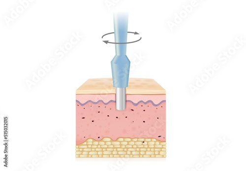 Turn the medical instrument and cut down to the skin layer to get sample tissue. Illustration about Biopsy punches for medical diagnosis and skin cancer treatment.