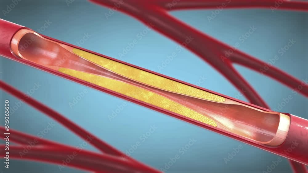 Stent implantation for supporting blood circulation into blood vessels during angioplasty - 3d illustration