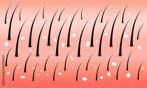 The scalp with dandruff vector. Dandruff in hair.