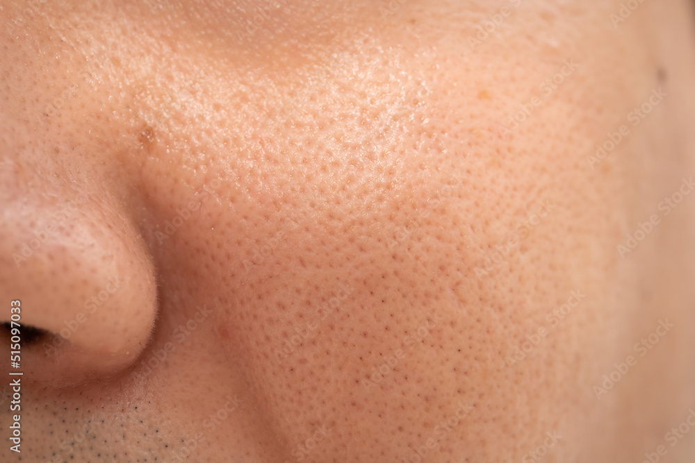 Asian male nose and cheek close up has skin problem, large pores, whitehead and blackhead pimple. Pores on the face of a man. - obrazy, fototapety, plakaty 