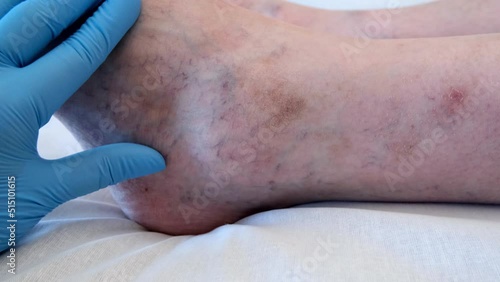 Varicose veins on a male leg. 4K footage photo