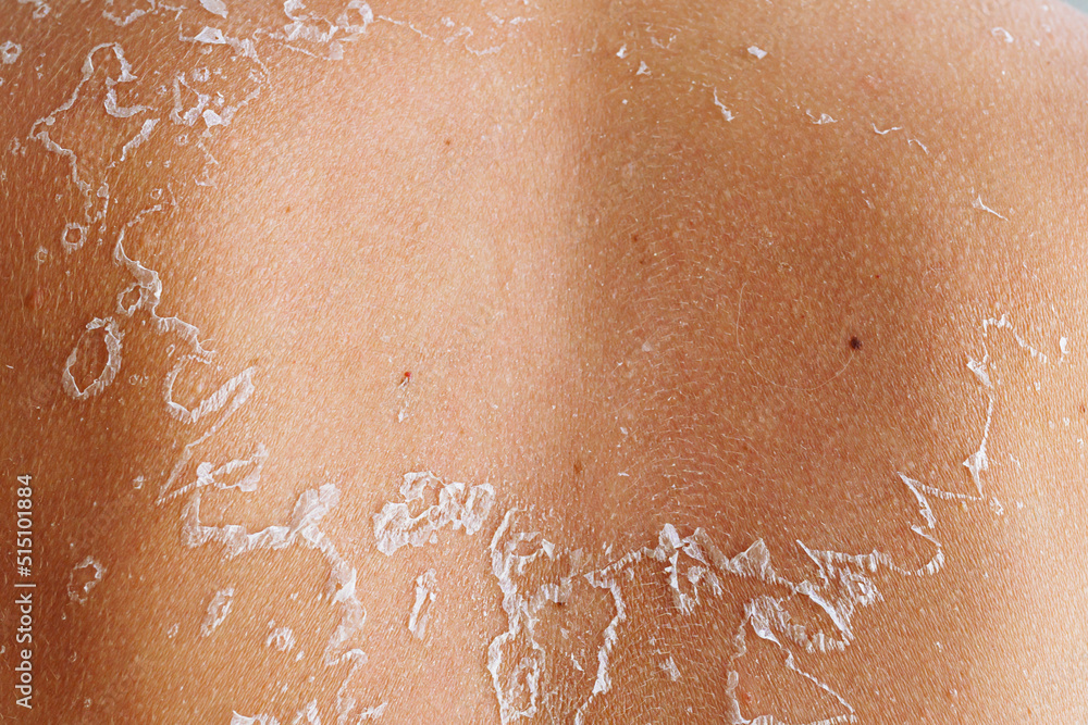 Fototapeta premium Cracked skin on back will peel off in pieces on female body