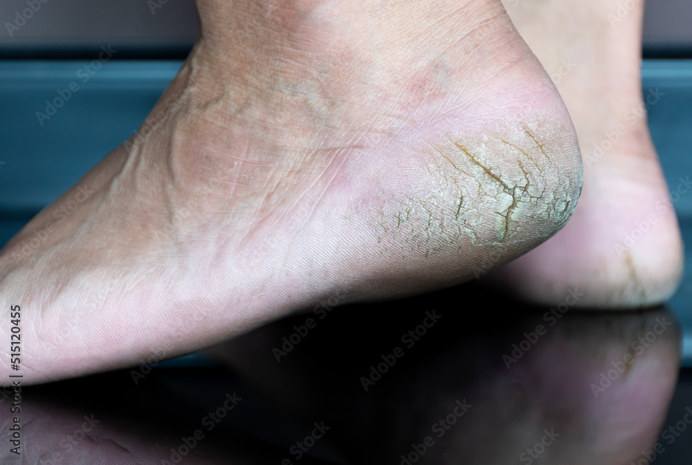 Close up cracked heel further deep cracks and dry flaky skin Close up cracked heel further deep cracks and dry flaky skin