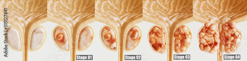 Prostate cancer all 4 stages - detailed close-up - 3D rendering
