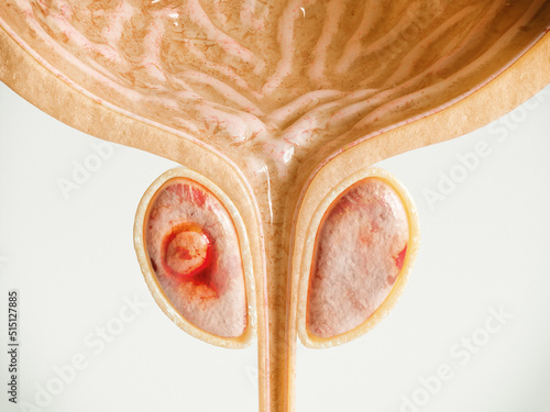 Prostate Cancer Stage 01 of 04 - Detailed High Quality 3D Rendering