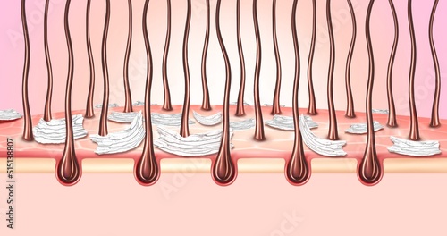3d illustration of dandruff and seborrhea. 3d illustration of hair. Medical illustration oily skin  photo