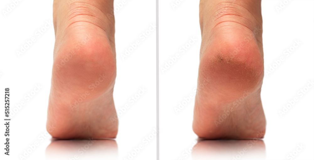 FootFresh Cream Treatment For Cracked Heels, Rough Feet & Dry Skin