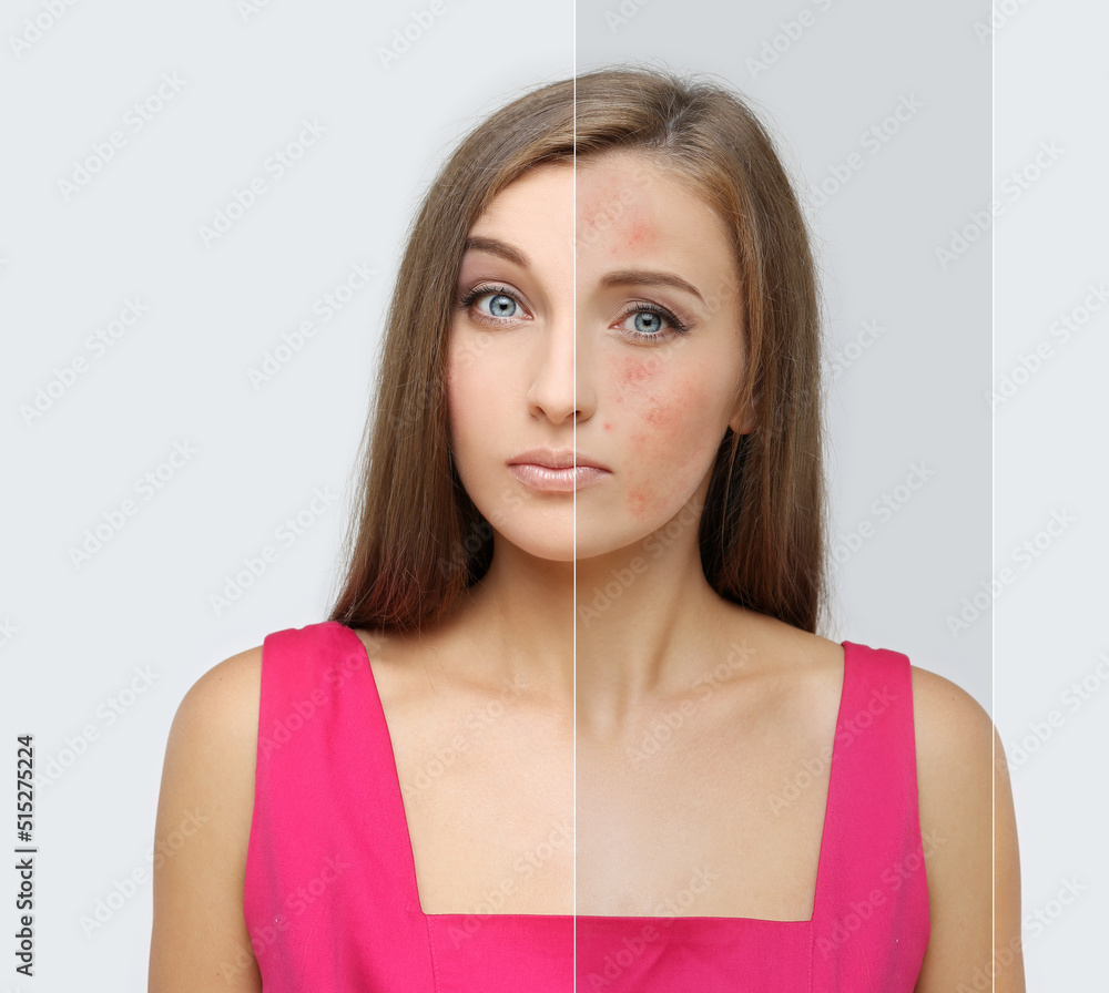 Acne,Skin concern,blemishprone skin and acne, Rosacea,different types