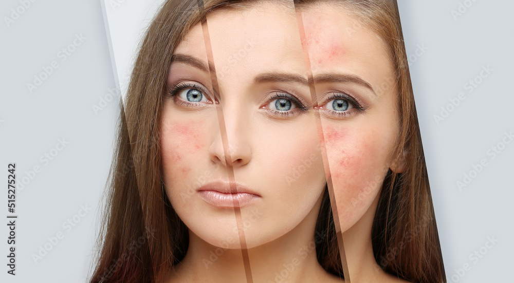 Acne,Skin concern,blemishprone skin and acne, Rosacea,different types