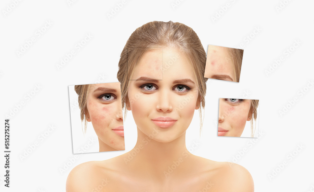 Acne,Skin concern,blemishprone skin and acne, Rosacea,different types