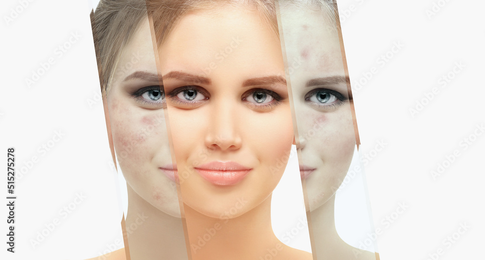 Acne,Skin concern,blemishprone skin and acne, Rosacea,different types