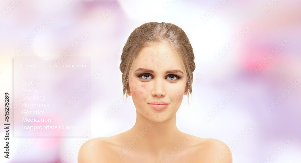 Acne,Skin concern,blemish-prone skin and acne, Rosacea,different types of acne Acne,Skin concern,blemish-prone skin and acne, Rosacea,different types of acne