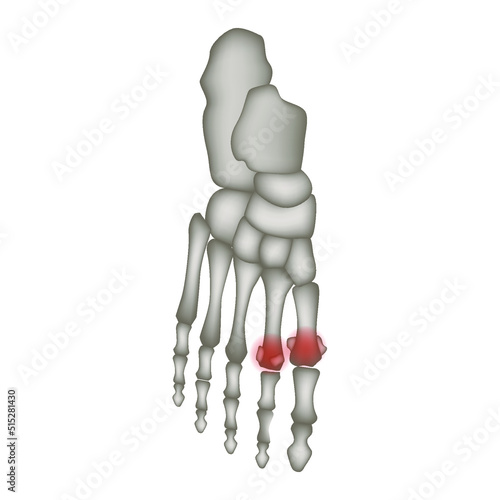 Freiberg disease. Aseptic necrosis of the metatarsal heads. Foot anatomy. Vector illustration