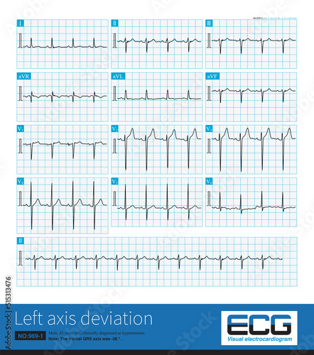 Male, 45 years old, suffering from hypertension. The frontal QRS axis was -38 °, which was not enough to diagnose left anterior fascicular block.Lead II QRS main wave is negative.