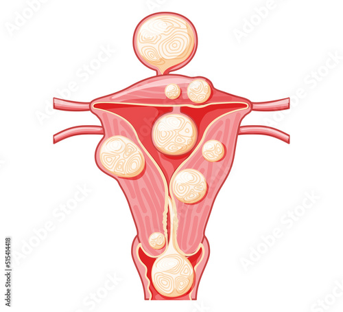 Set of Uterine fibroids Female leiomyomas reproductive system uterus in different styles and cross sections. Front view in a cut. Human anatomy medical illustration isolated internal organs flat icon