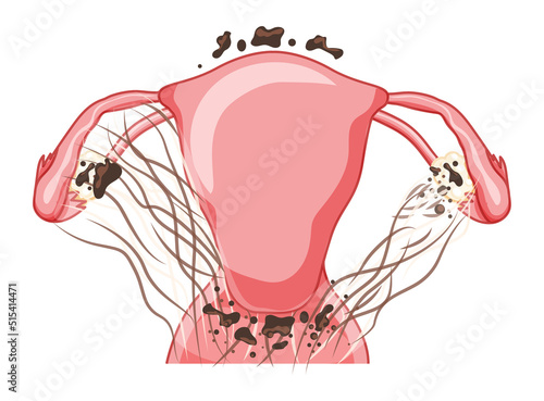 Endometriosis 4 stage Female reproductive system pain pcos tissue cancer cyst uterus. Front view. Human anatomy internal organs location scheme, cervix, ovary, fallopian tube flat style icon.