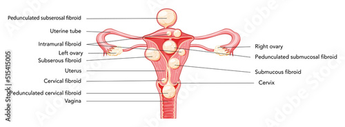 Uterine fibroids Female leiomyomas reproductive system uterus diagram with inscriptions in Latin text. Human anatomy medical illustration isolated internal organs location scheme, cervix flat icon