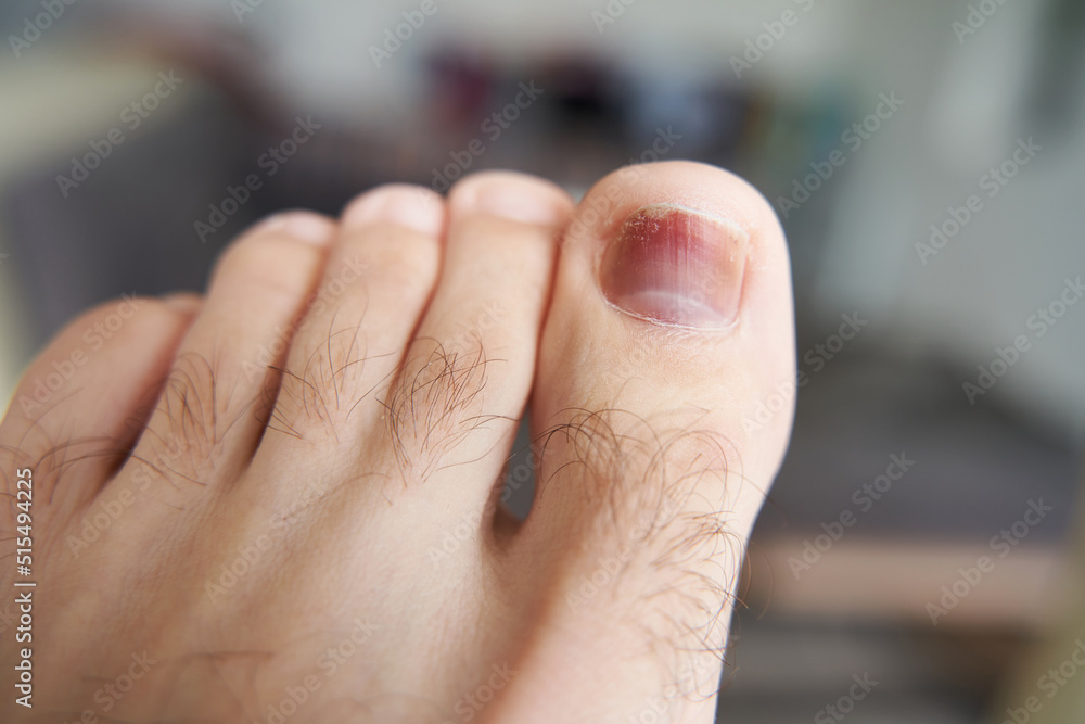 Fototapeta premium A toe is injured, a heavy object has fallen on the finger. Hematoma under the nail