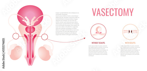 Human Anatomy of Vasectomy on White Background

