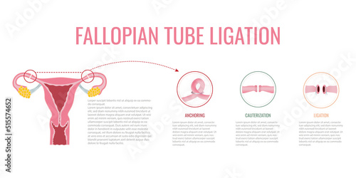 Fallopian tube ligation. types of tubal ligation on white background. surgical procedure. flat vector. photo