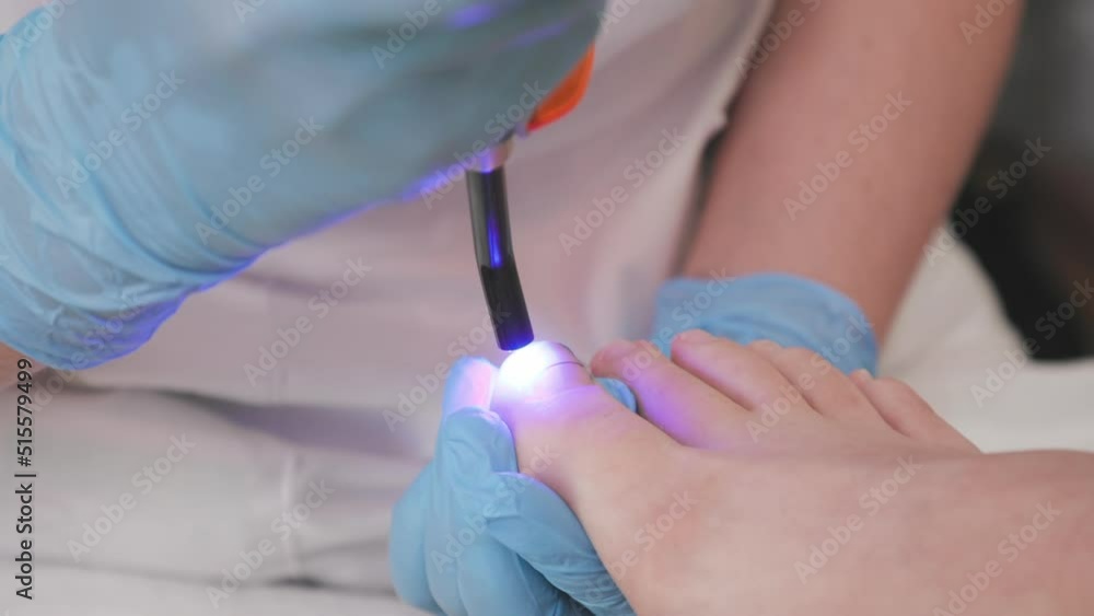 Professional chiropodist installs a titanium thread on the big toe and using UV gadget. Correction of ingrown toenail. The concept of podology, orthopedics and chiropody. Professional chiropodist installs a titanium thread on the big toe and using UV gadget. Correction of ingrown toenail. The concept of podology, orthopedics and chiropody.